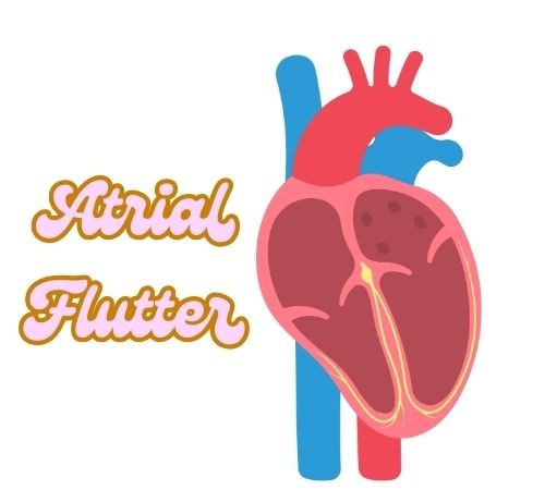 Atrial Flutter