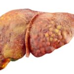 fatty liver disease