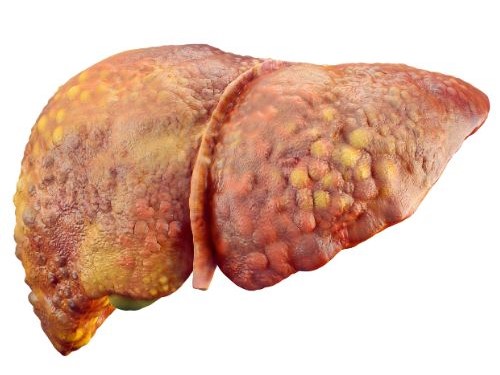 fatty liver disease