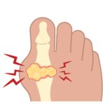 Gout disease