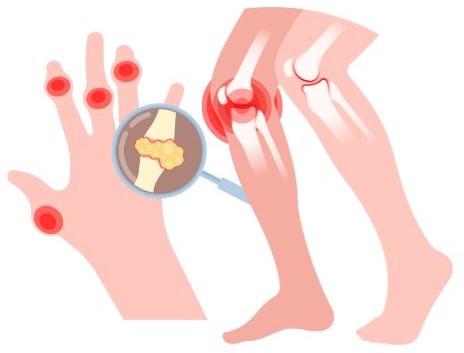 Osteoarthritis