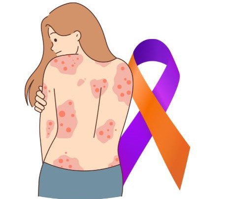 Psoriasis