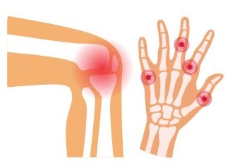 Rheumatoid Arthritis