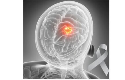 4 stage Brian cancer