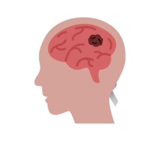 brain cancer