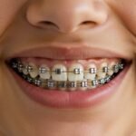 How Much Do Braces Cost? all you need to know about Prices and Options braces cost
